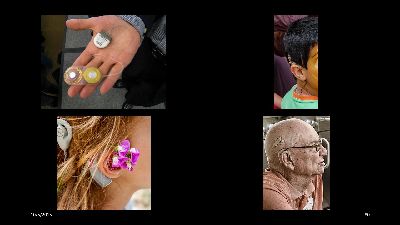 cochlearimplant
