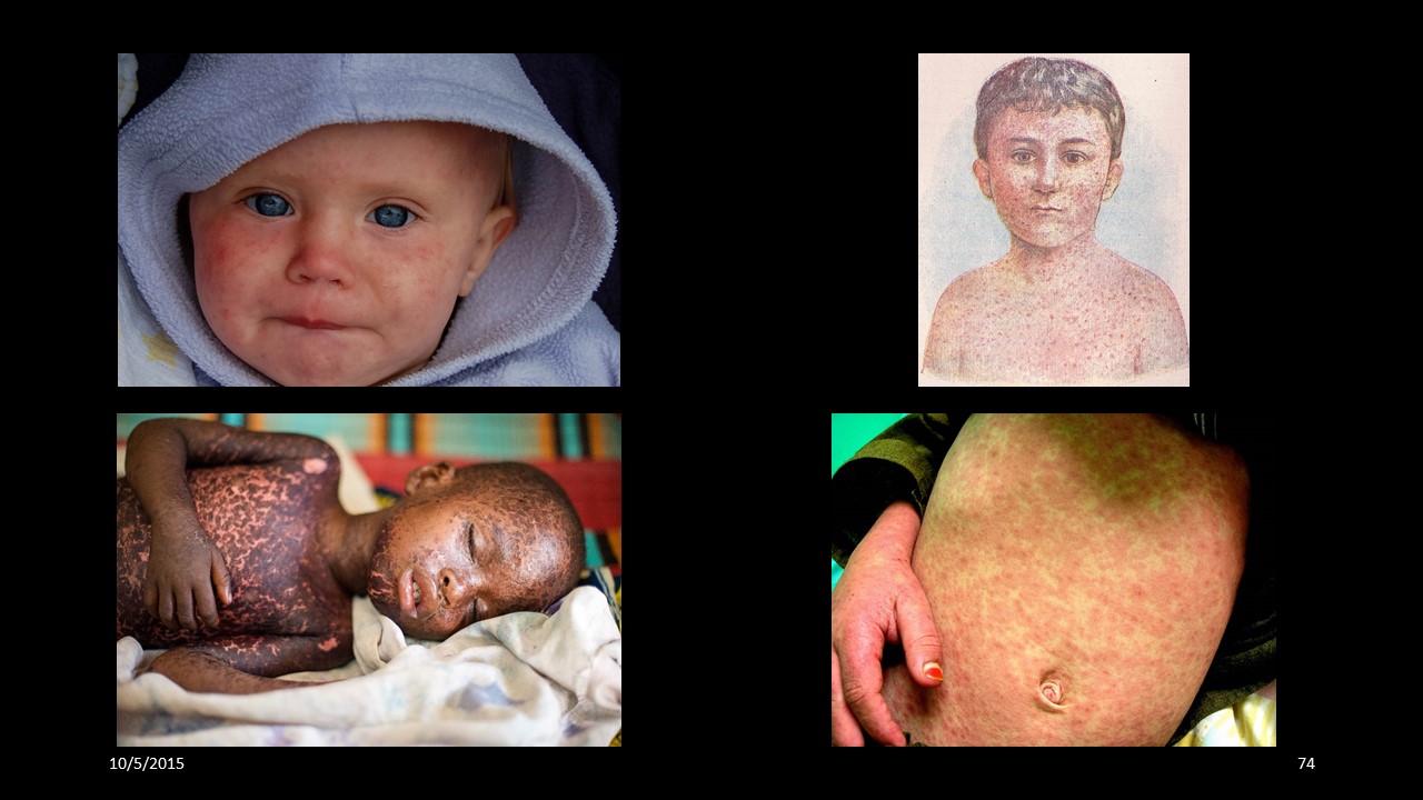 measles